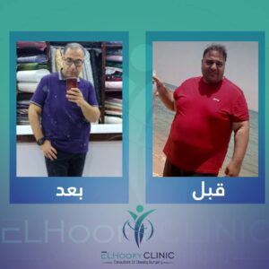 تكميمقبل وبعد