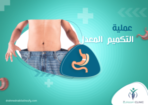 عملية -التكميم- المعدل
