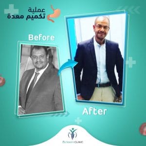 تكميم-قبل-بعد-فى-مصر