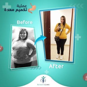 التكميم-قبل-وبعد
