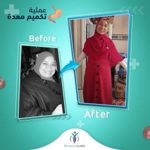 تكميم-المعدة-بالمنظار-قبل-وبعد