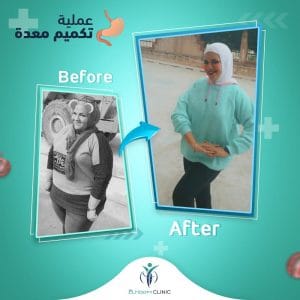 تكميم-قبل-وبعد