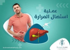 إستئصال-المرارة-بالمنظار