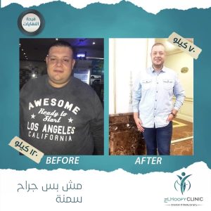 تكميم-المعدة-لخسارة-الوزن