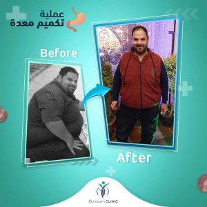 مريض-تكميم-المعدة