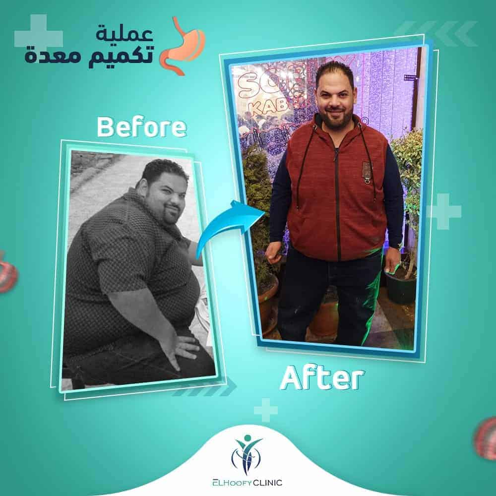 مريض-تكميم-المعدة