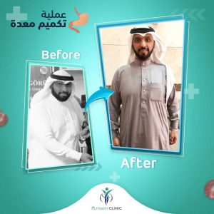 تكميم-المعدة-السعودية