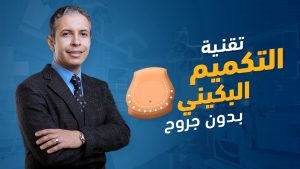 تقنية-التكميم-البكيني