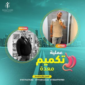 حالة-قبل-وبعد-التكميم