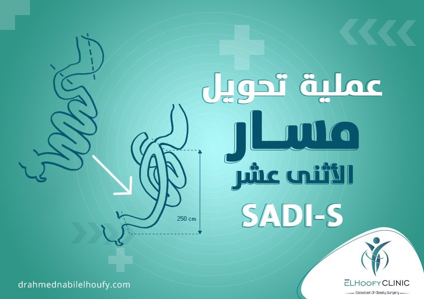 ما هي عملية تحويل مسار الإثنى عشر SADI-S؟