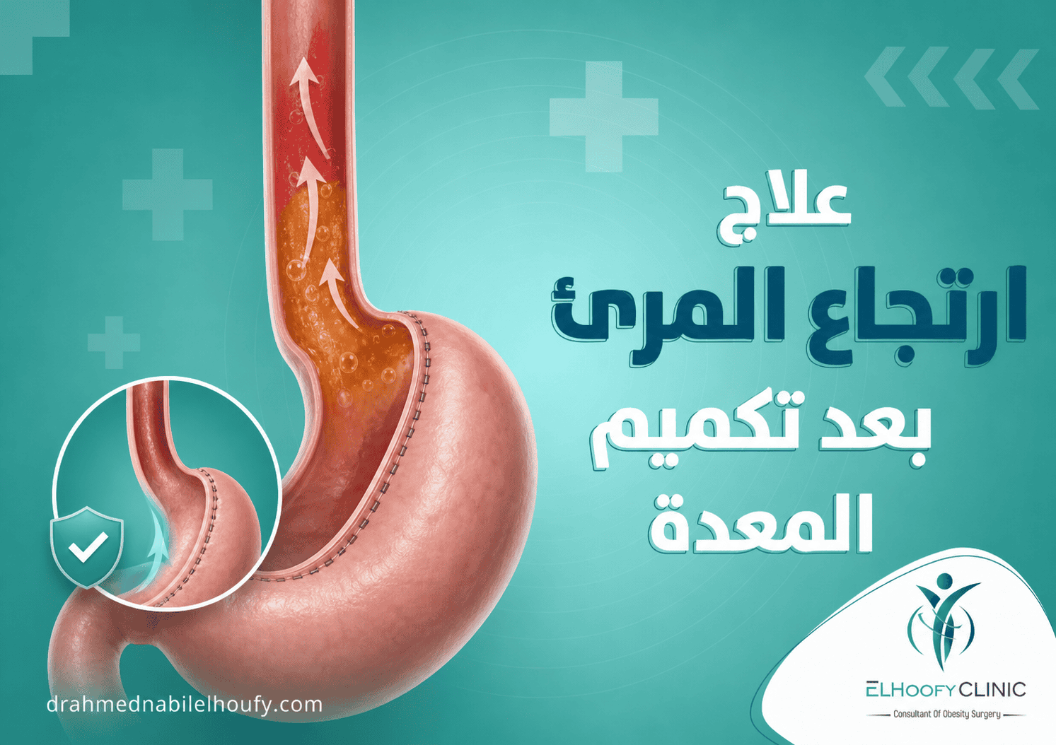 لماذا يحدث ارتجاع المريء بعد التكميم وعلاجه؟